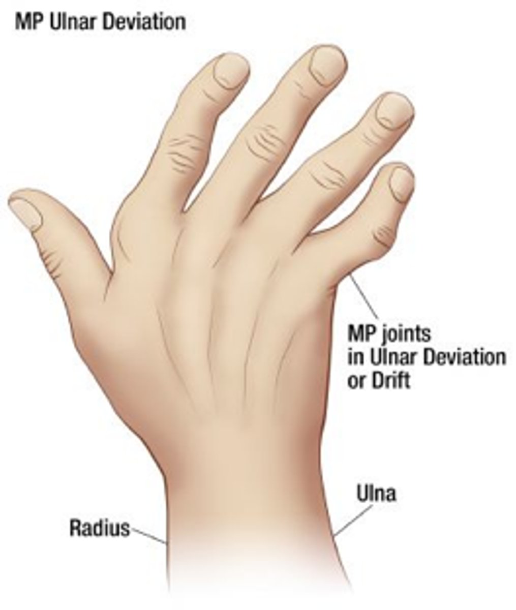 <p>1) RA</p><p>2) radial deviation of wrist</p><p>3) ulnar deviation of MCPs</p>