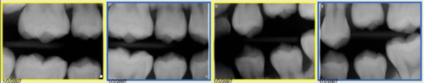 <p>what is the approximate age of this patient?</p><p>a. 7-8</p><p>b. 9-10</p><p>c. 11-12</p><p>d. 13-14</p>