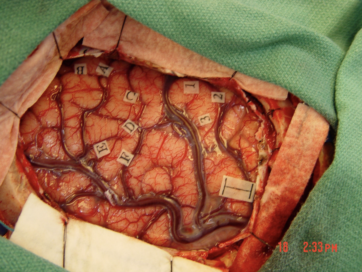 The photograph below is from a neurosurgical case in Duke University Hospital. The neurosurgeon has just completed intra-operative mapping of key functional sites related to somatic sensation, motor control, and language processing (the small pieces of papers with letters and numbers indicate those sites and the scale bar = 1 cm). The patient remained awake and conversant throughout this phase of the operation. In order to perform this functional analysis intraoperatively, which layer(s) of the meninges must remain intact (after the other layer(s) have been dissected away)?

A. pia mater only need remain intact
 B. dura mater, arachnoid mater, pia mater all must remain intact
 C. arachnoid mater and pia mater both must remain intact
 D. arachnoid mater only need remain intact
 E. dura mater only need remain intact