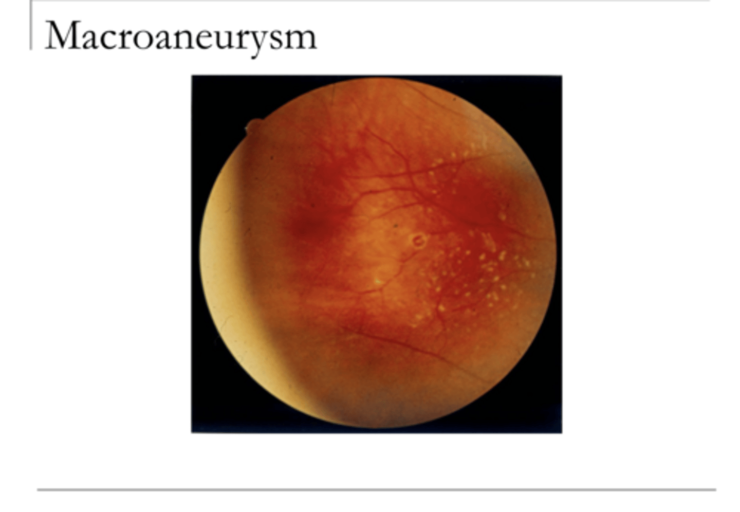 <p>Macroaneurysm (Pic)</p>