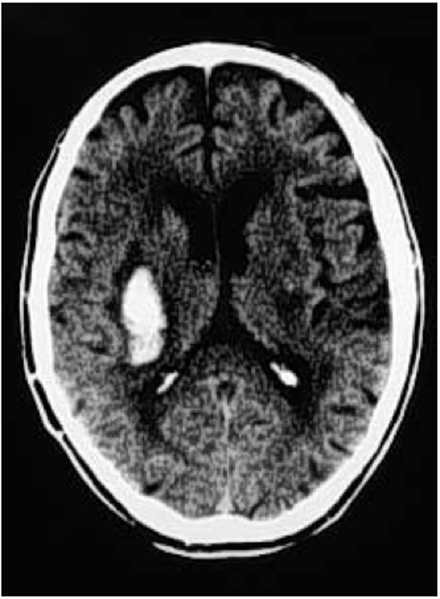 <p>bleeding within the brain tissue</p>