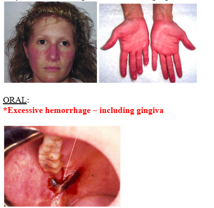 <p><span style="background-color: transparent; font-family: "Times New Roman", serif;">*<strong>Older adults ~ 60 yrs</strong></span></p><p><span style="background-color: transparent; font-family: "Times New Roman", serif;">*Symptoms: nonspecific – HA, weakness, dizziness, visual disturbances, sweating, weight loss</span></p><p><span style="background-color: transparent; font-family: "Times New Roman", serif;">*<strong>Ruddy complexion</strong></span></p><p><span style="background-color: transparent; font-family: "Times New Roman", serif;">*<strong>Pruritis – 40%</strong></span></p><p><span style="background-color: transparent; font-family: "Times New Roman", serif;">*Transient ischemic attacks, stroke, heart attacks – related to thrombosis</span></p><p><span style="background-color: transparent; font-family: "Times New Roman", serif;">*Erythema and burning of hands and feet, gangrene and necrosis (related to thrombosis)</span></p><p><br><span style="background-color: transparent; font-family: "Times New Roman", serif;"><u>ORAL</u>:</span></p><p><span style="background-color: transparent; font-family: "Times New Roman", serif;"><strong>*Excessive hemorrhage – including gingiva</strong></span></p>