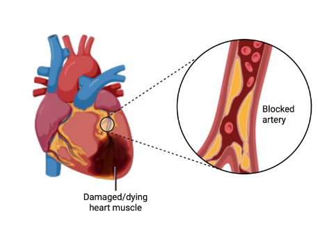<p>- Ratio of LDL:HDL essential for effective reverse cholesterol transport</p><p>- Cholesterol blood test: monitors concentrations of these lipoproteins</p><p>- Dietary absorption of cholesterol itself is poor, however some dietary patterns increase LDL</p><p>- LDL exceeds needs of tissues, overwhelms capacity for cholesterol scavenging by HDL</p><p>- Major cause of cardiovascular disease</p><p>- Pharmacological management - inhibit HMG CoA reductase with statins</p><p></p><p>- remember that HMG-CoA endogenously synthesises. We are limiting its natural syntrhesis becuase our diet has too much</p>