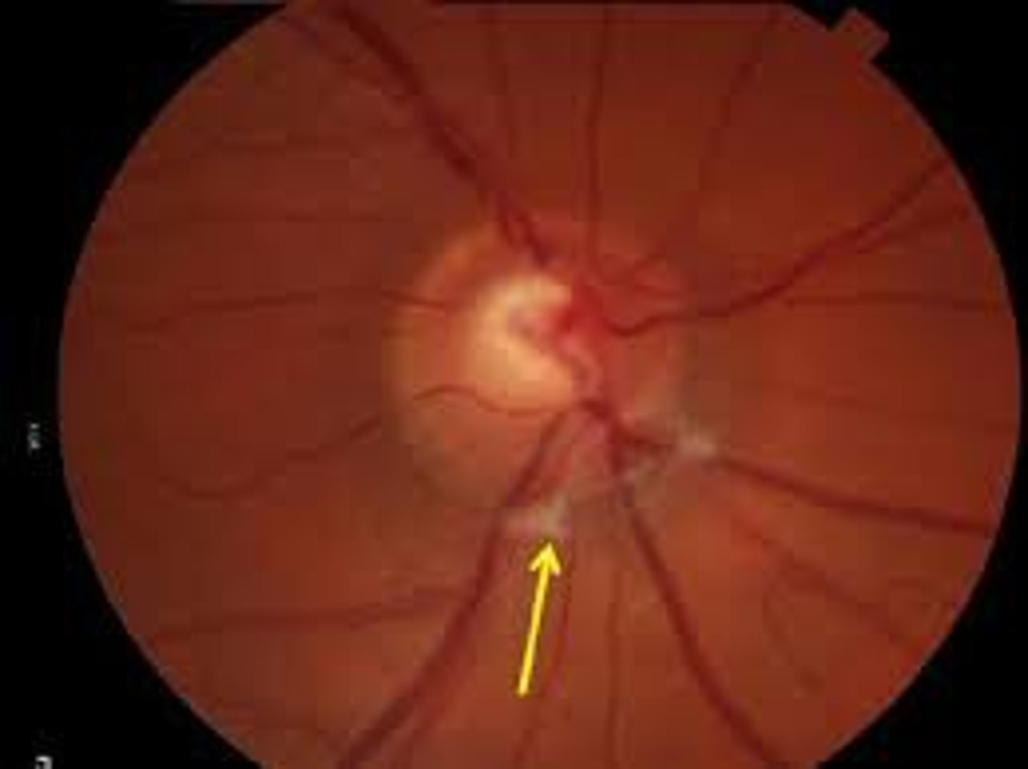 <p>small tuft of fibrous tissue that remains at the optic disc (posterior attachment)</p>