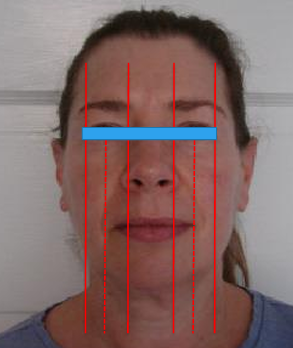 <p>-mild asymmetry is considered to be normal</p>
