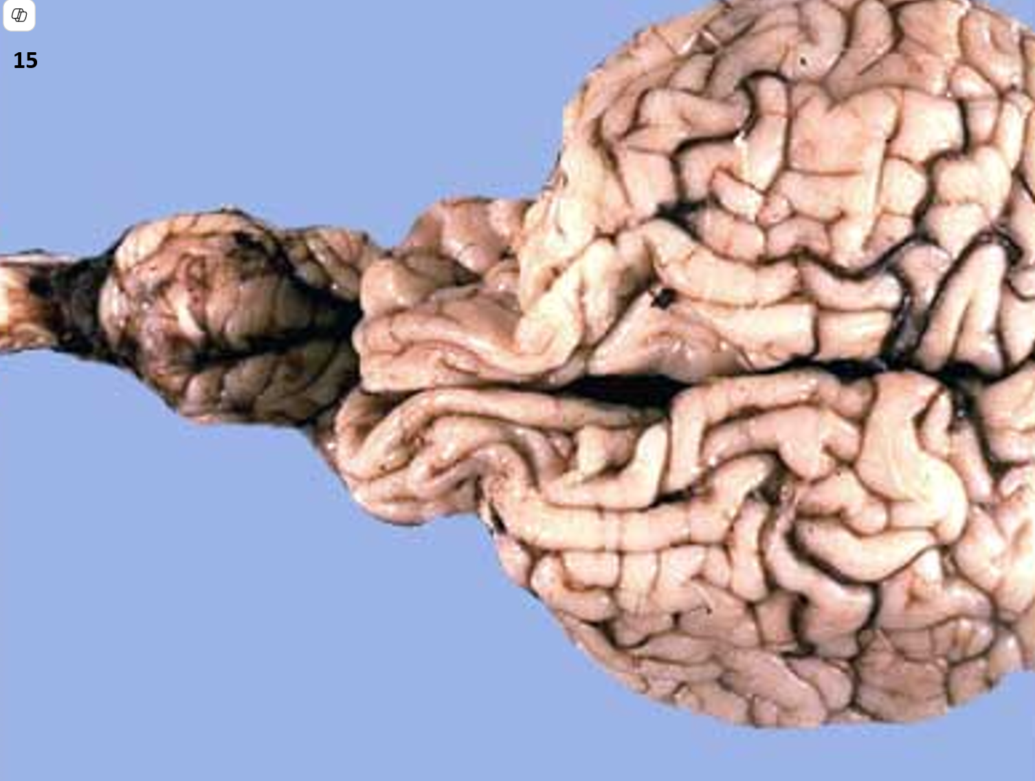 <p>15.<span>&nbsp; </span>Tissue from a calf.<span>&nbsp; </span>Name this condition.</p><ol type="a"><li><p>Cerebellar hypoplasia</p></li><li><p>Dandy-Walker malformation</p></li><li><p>Arnold-Chiari malformation</p></li><li><p>Cerebellar abiotrophy</p></li></ol><p></p>