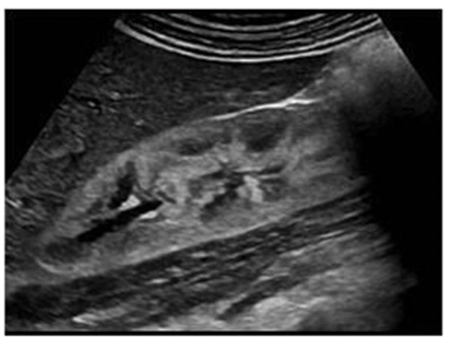 <p><span>Acute Glomerulonephritis:</span></p>