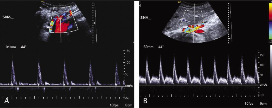 <p>Which SMA waveform is post-prandial? </p>