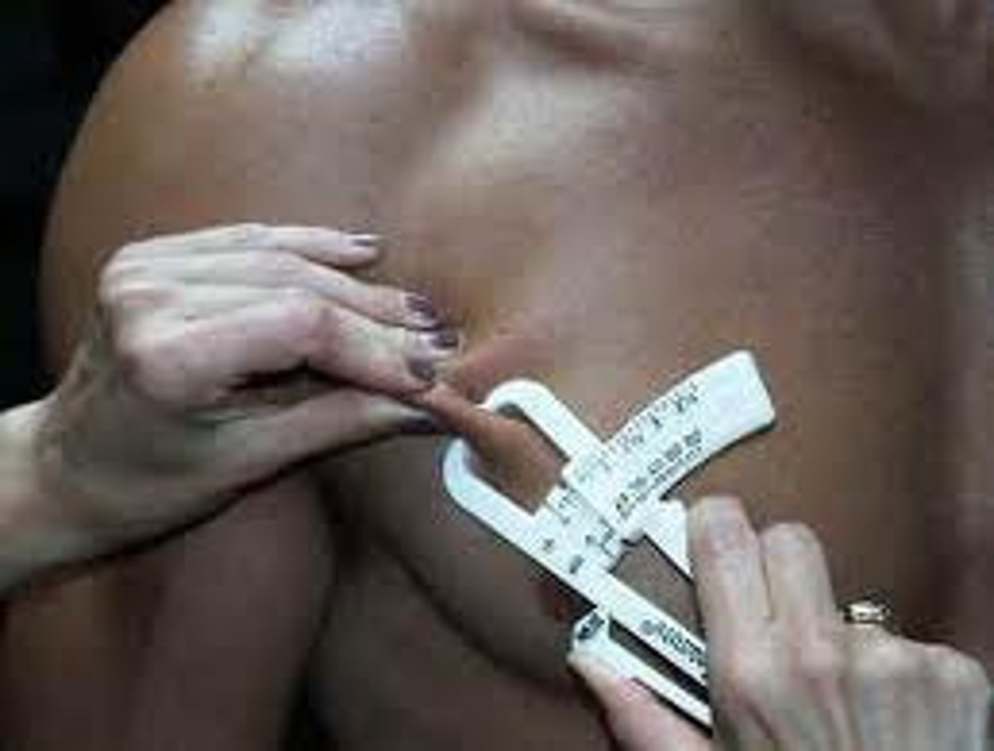 <p>One-half the distance between the anterior axillary line and the nipple (men), or one-third of the distance between the anterior axillary line and the nipple (women)​</p><p>Diagonal ​</p>