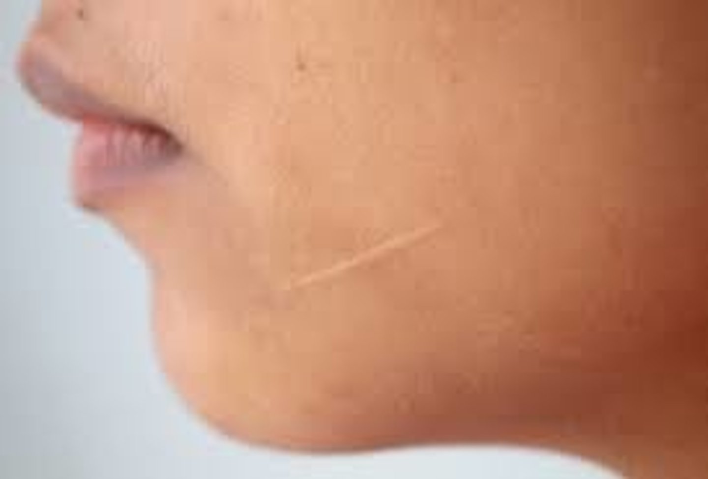 <p>Thin to thick fibrous tissue that replaces normal skin following an injury or laceration of the dermis</p>