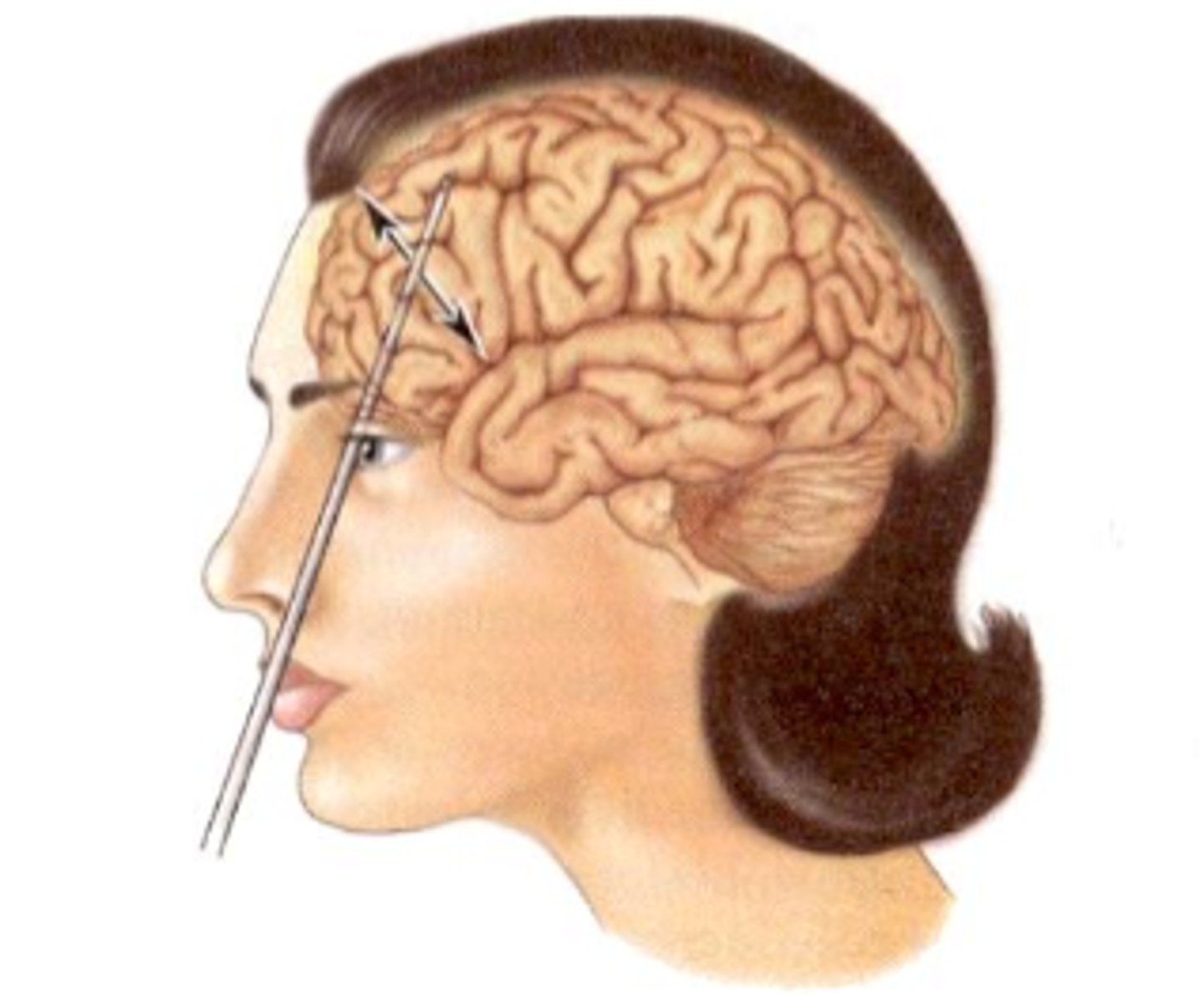 <p>a psychosurgical procedure once used to calm uncontrollably emotional or violent patients. The procedure cut the nerves connecting the frontal lobes to the emotion-controlling centers of the inner brain. Literally did not work and was used in the 30's-60's cause they didn't know how the brain worked.</p>