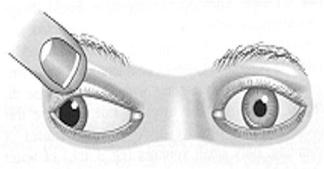 <p>Which condition is <strong>diplopia, ptosis, dilation of pupil, & fixed position of eye downward and outward?</strong></p>