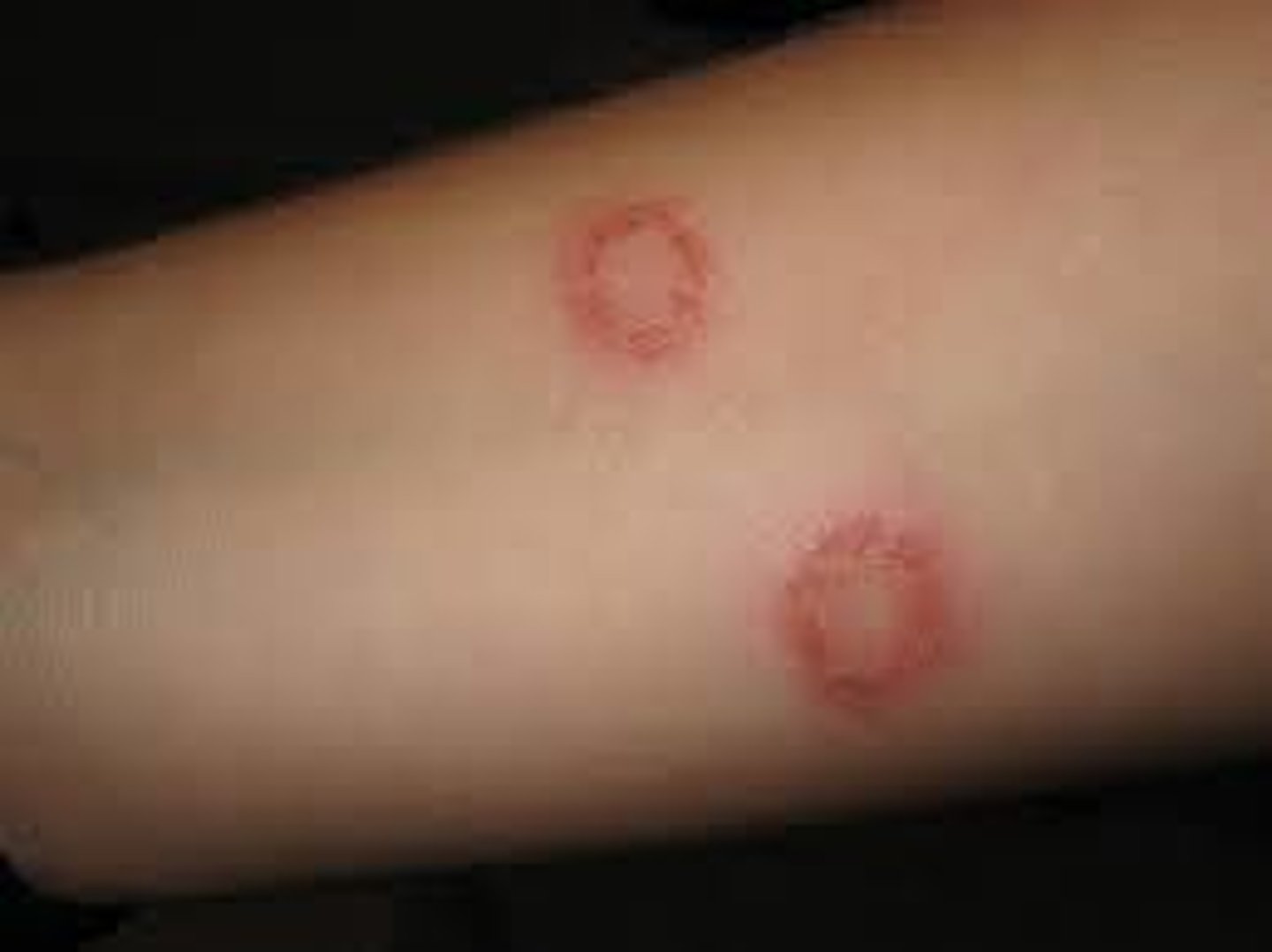 <p>ringworm</p>