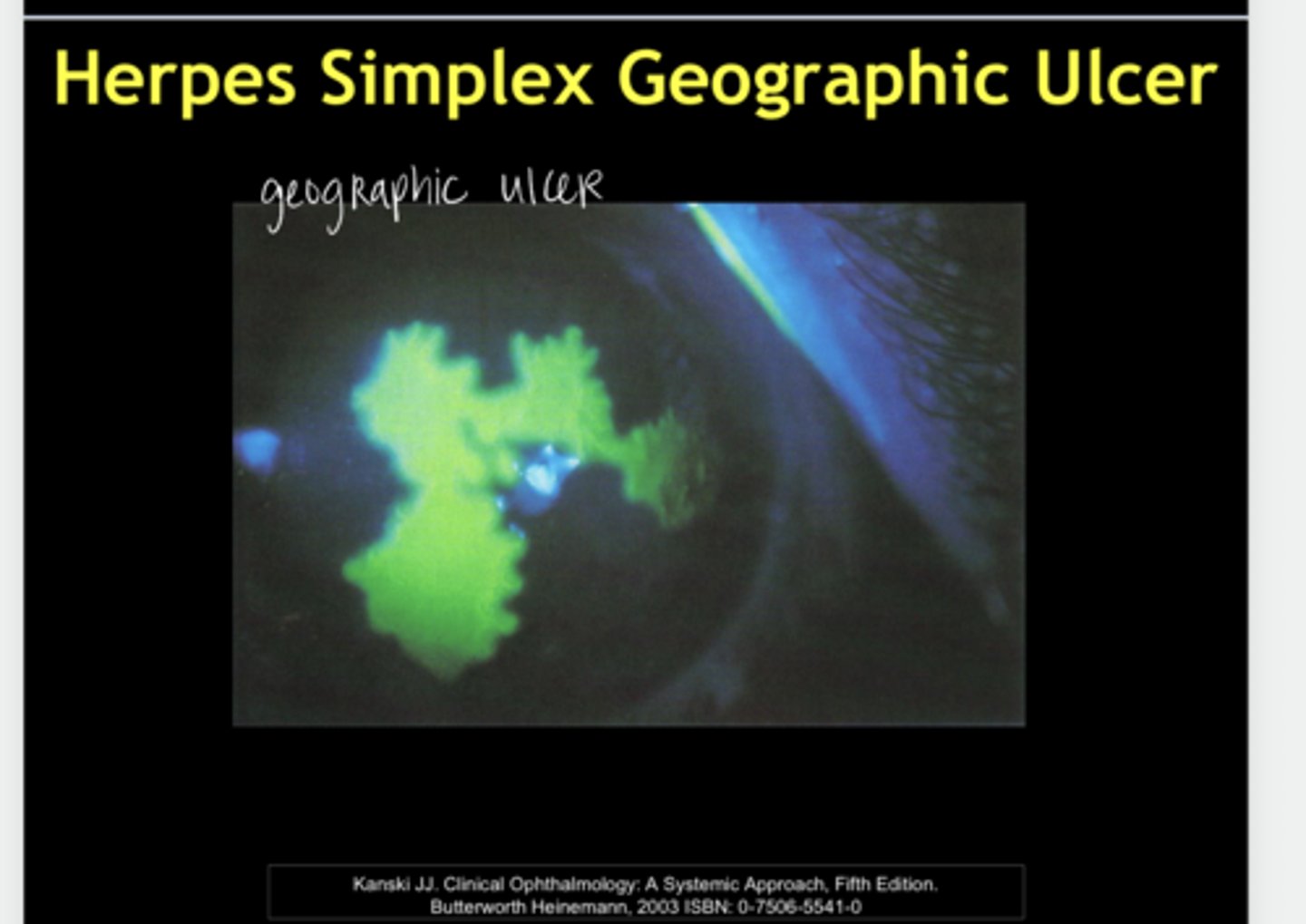 <p>Herpes Simplex Epithelial Keratitis -- Geographic Ulcer (Pic)</p>