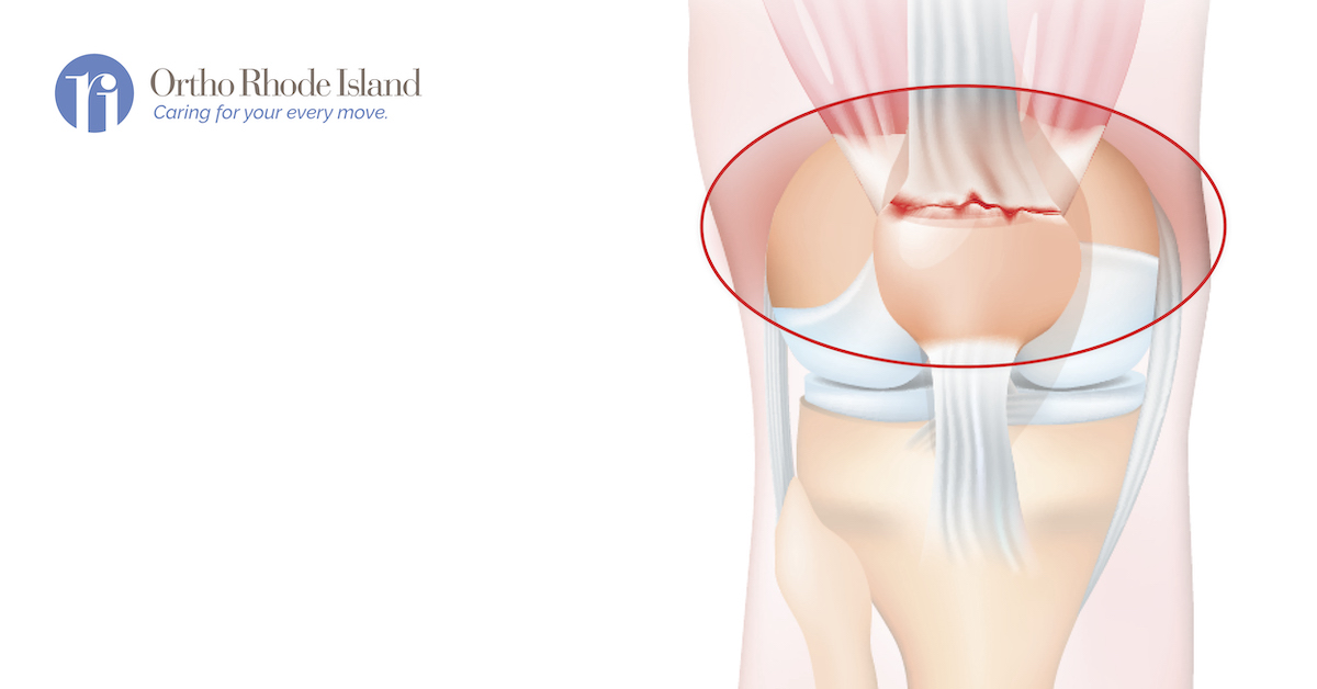 <p>top part over the patella</p>