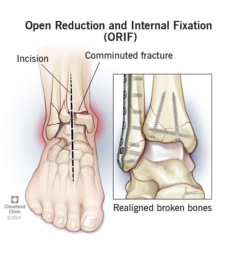 <p>C. ORIF open reduction internal fixation </p>