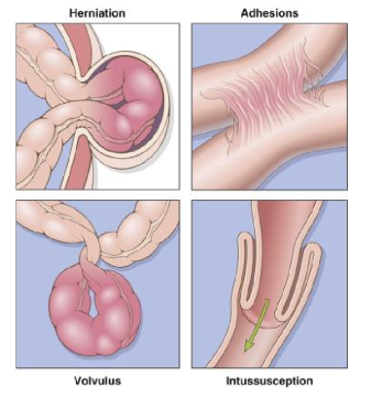 <p>herniation</p><p>adhesions</p><p>volvulus</p><p>intussception</p>