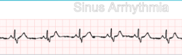 All aspects present: P wave, QRS, and T wave.
R-R distance varies**.