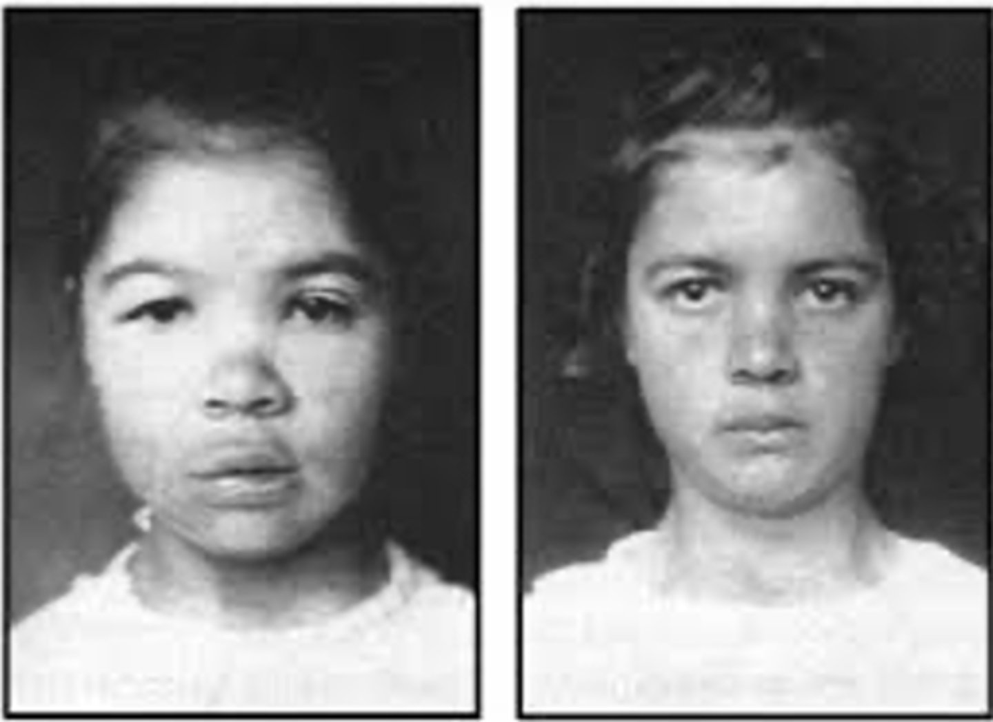 <p>occurs when infant is born with INADEQUATE thyroid function; can lead to delayed physical and nervous system development- potential mental retardation if left untreated</p>