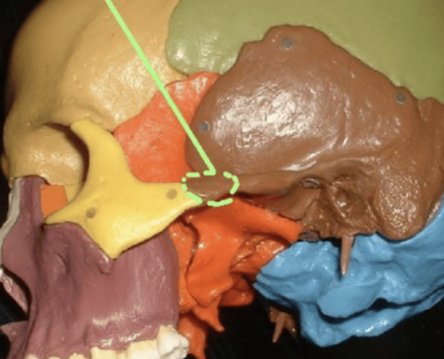 <p>zygomatic process of temporal bone</p>