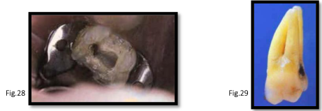 <p>canal anatomy of <strong>mx 2nd molar</strong></p>