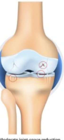 <p>Which stage of OA is characterized by moderate osteophytes, definite JSN, sclerosis, possible bone end deformity</p>