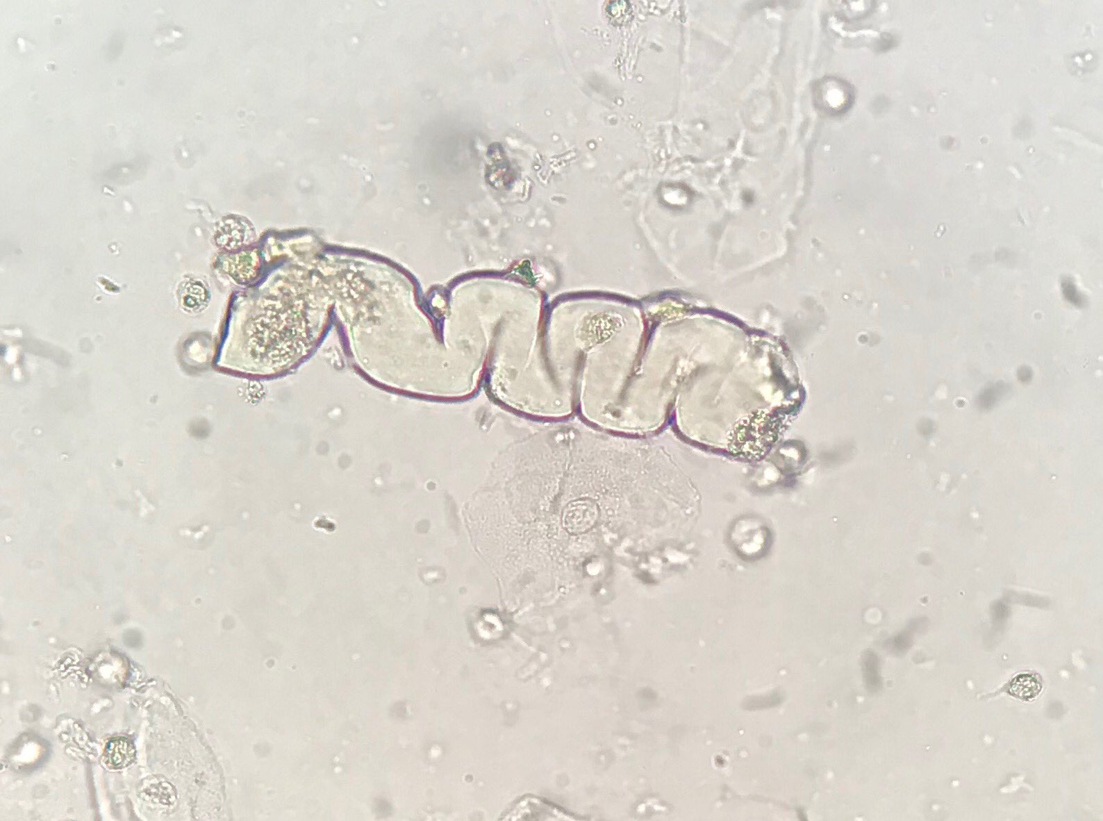 <p>Appear as smooth homogenous cylinders with blunt broken ends and cracked and serrated edges that are highly refractile.</p><p>Associated with severe chronic renal failure, malignant hypertensions, diabetic nephropathy, acute renal disease, and renal transplant rejection.</p>