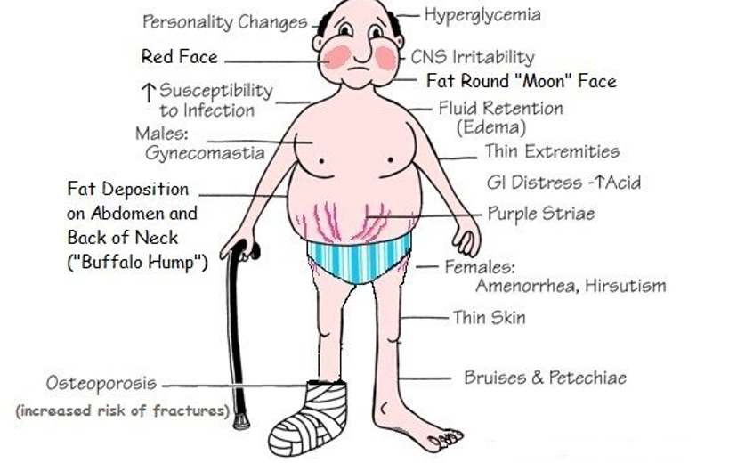 <ul><li><p>Central Obesity</p></li><li><p>Buffalo hump</p></li><li><p>Moon face with red checks</p></li><li><p>Thin and fragile extremities</p></li><li><p>Osteoporosis</p></li><li><p>GI distress / bleed</p><ul><li><p>decrease mucus production in the stomach</p></li></ul></li><li><p>Purple Striae</p></li><li><p>Visual disturbances (if they have pituitary tumor)</p></li><li><p>Hyponatremic  </p><ul><li><p>Excess production of cortisol</p></li><li><p>This causes them to be hypokalemic, hypocalcemic</p></li></ul></li></ul><p></p>