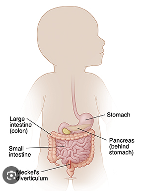 <p>meckel’s diverticulum.</p><p>outpouching of the small intestine occurs, vitelline duct forms a ligament between the midgut and the anterior abdominal wall</p>