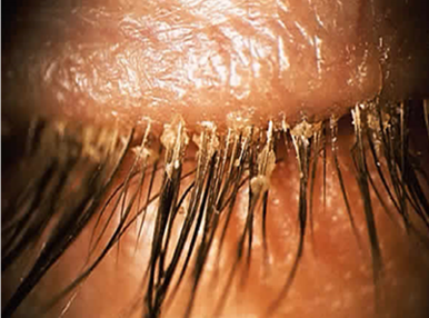 <p>><mark data-color="red" style="background-color: red; color: inherit;"> Bacterial</mark> - staphylococcal</p><p></p><p>> <strong>Sebhorrheic</strong> —> excess lipid - Gland of Zeiss</p><p></p><p>> <strong>demodex - mite</strong></p>