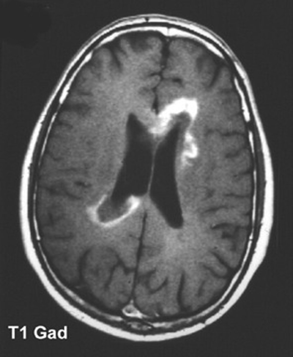 <p>paraventricular plaques</p>