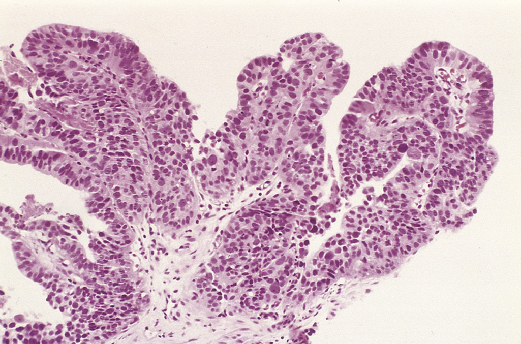  A 65-year-old man recently retired after many years

in a job that involved exposure to aniline dyes, including β-naphthylamine. One month ago, he had an episode of hematuria that was not accompanied by abdominal pain. On physical examination, there are no abnormal findings. Urinalysis shows 4+ hematuria, and no ketones, glucose, or protein. Microscopic examination of the urine shows RBCs that are too numerous to count, 5 to 10 WBCs per high-power field, and no crystals or casts. The result of a urine culture is negative. Cystoscopy is performed, and biopsy of a lesion reveals the microscopic appearance in the figure. Which of the following neoplasms is he most likely to have?