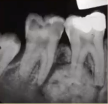 <p>benign neoplasm of cementum, <strong>VITAL</strong> teeth but <strong>PAINFUL</strong> </p>