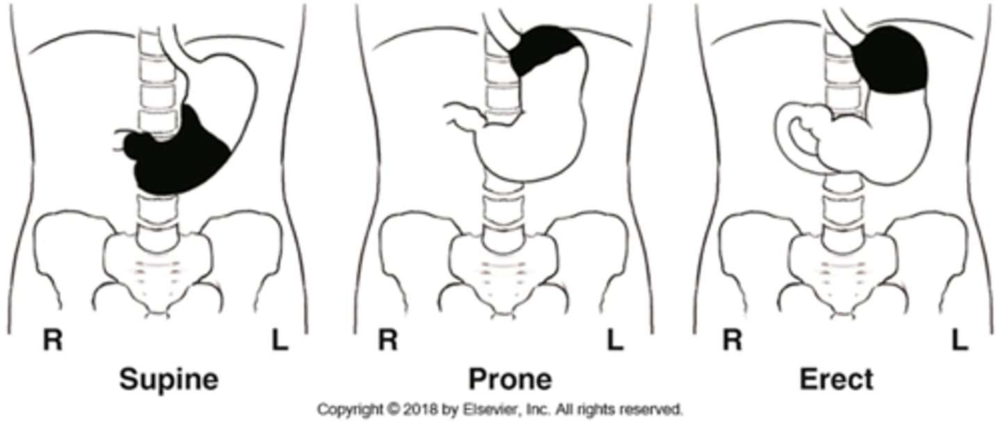<p>A) Body and pylorus</p>