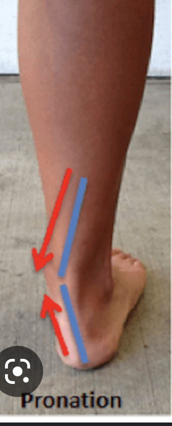 Inward rolling of the foot 