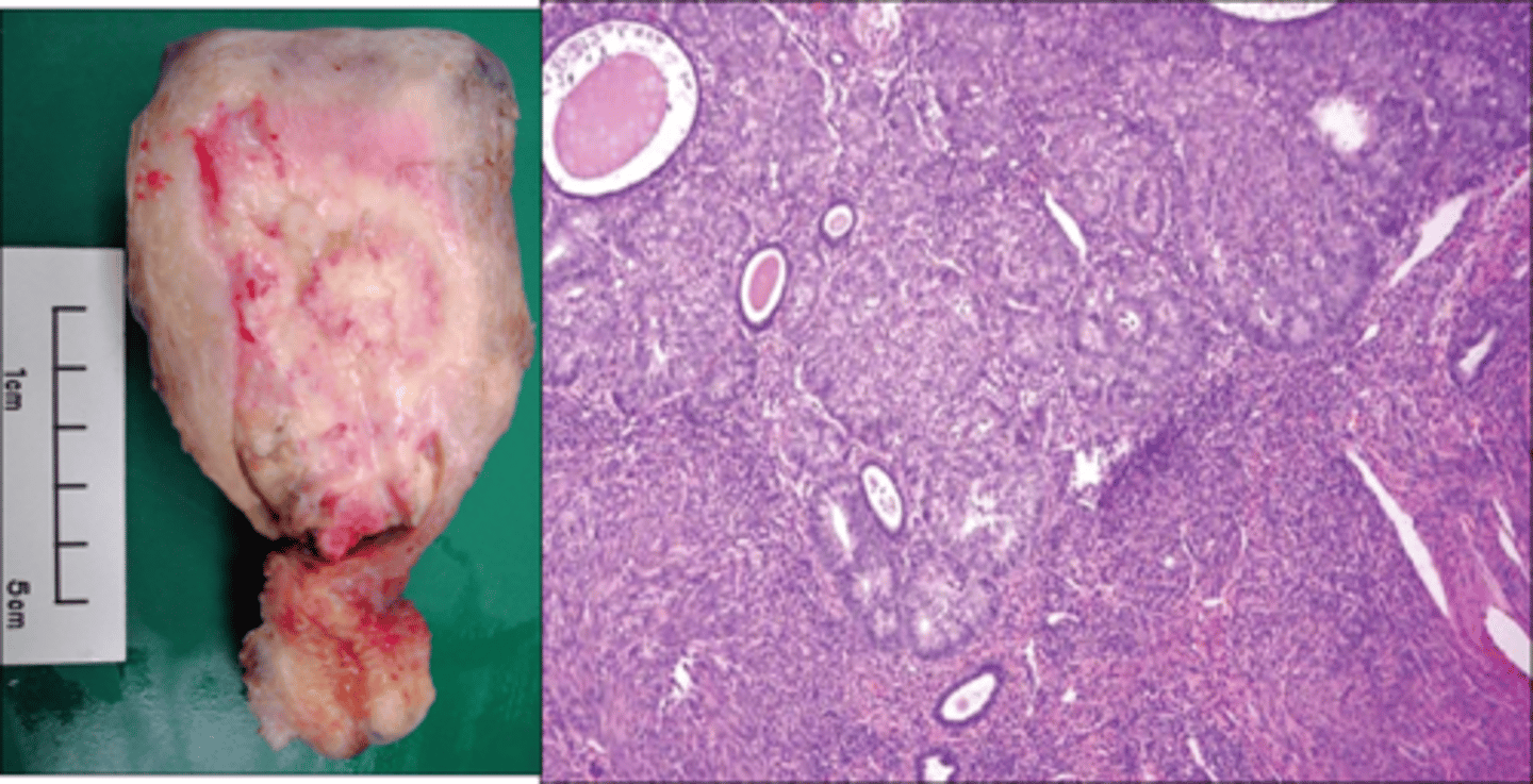 <p>- Post menopausal bleeding</p><p>Biopsy</p><p>- ↑ nuclear-to-cytoplasmic ratio</p><p>- irregularity in size &amp; shape of the nuclei</p>