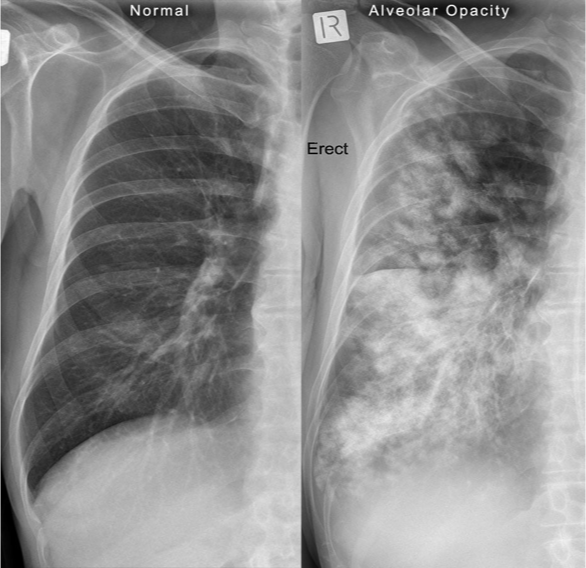 <p>Radiographic finding described as poorly marginated density or “fluffy”</p>