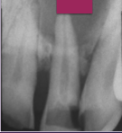 <p>What is a periapical cyst?</p>