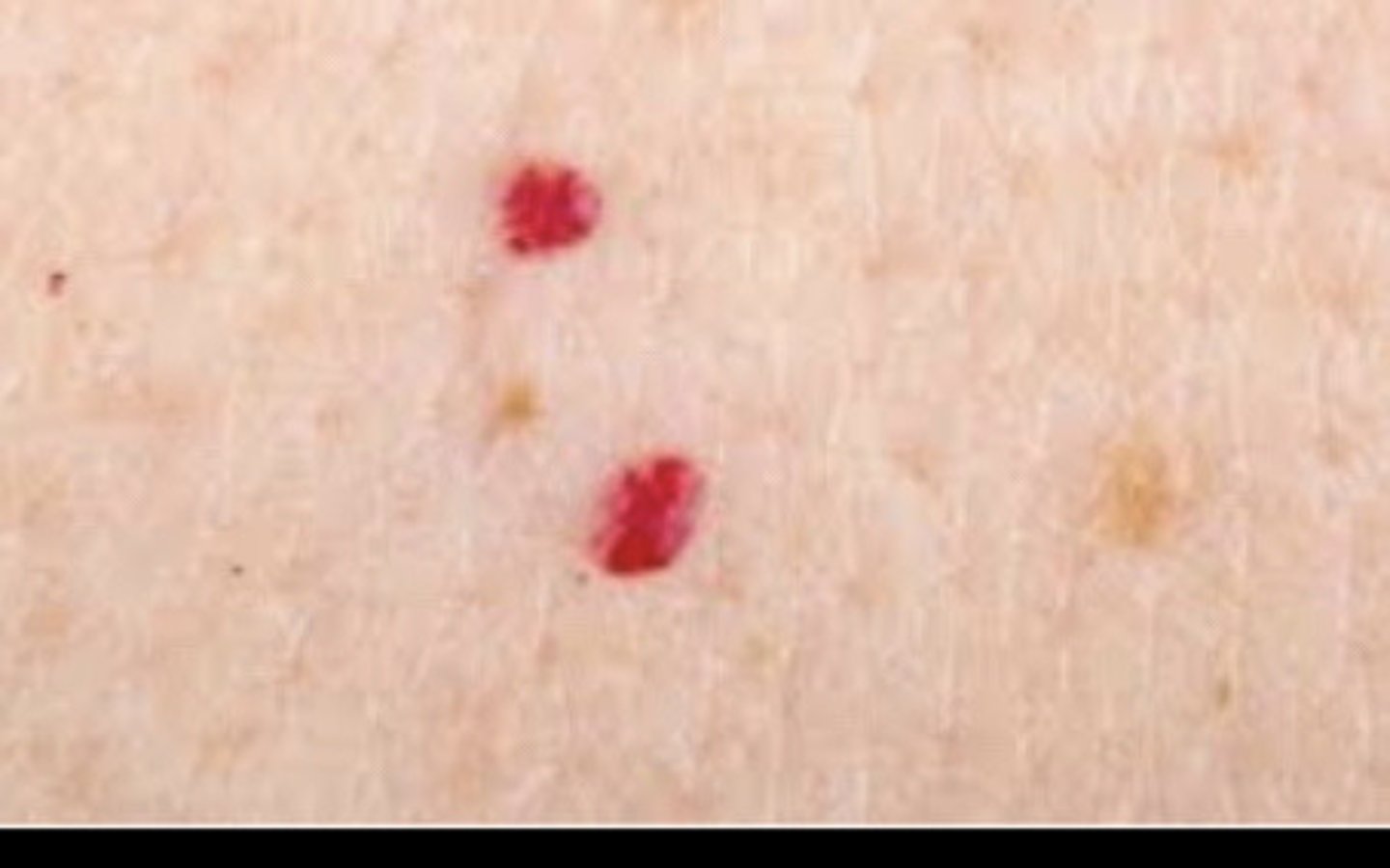 <p>Cherry Angioma</p>