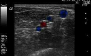 <p>This is an image of the RUE. Which vessel is medial? </p>