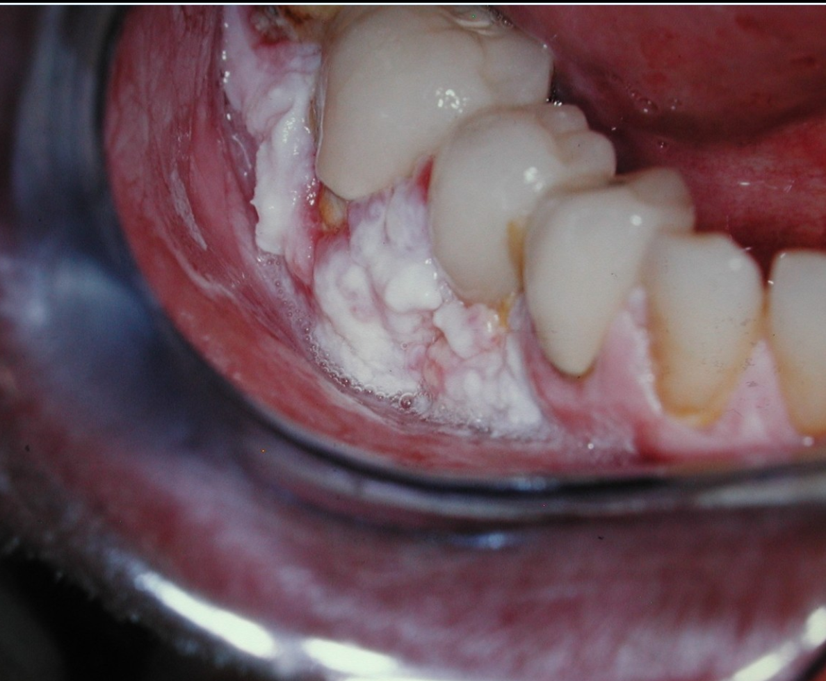 <p>6c. All of the following are unique clinical features of PVL EXCEPT:</p><p><span><span>Multiple locations and can spread</span></span></p><p><span><span>Gingiva is usually involved</span></span></p><p><span><span>Wipes off </span></span></p><p><span><span>High recurrence rate</span></span></p>