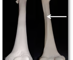 Narrow ridge of bone; less prominent than a crest