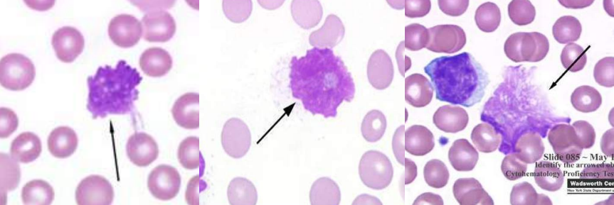 <p>A. Identify the abnormality / cell</p><p>B. This is seen in what condition / disease</p>