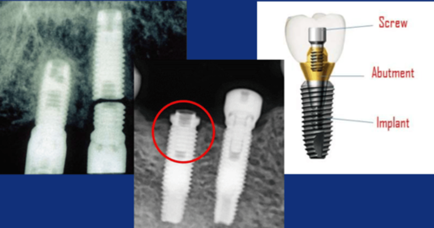 <p>- breakage of screw &amp;/or abutment</p><p>- can usually be managed</p>