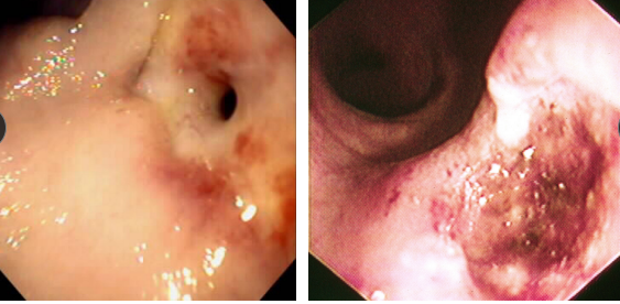 <p><span style="background-color: transparent;"><strong><span>Gastroduodenal Ulcers</span></strong></span></p>