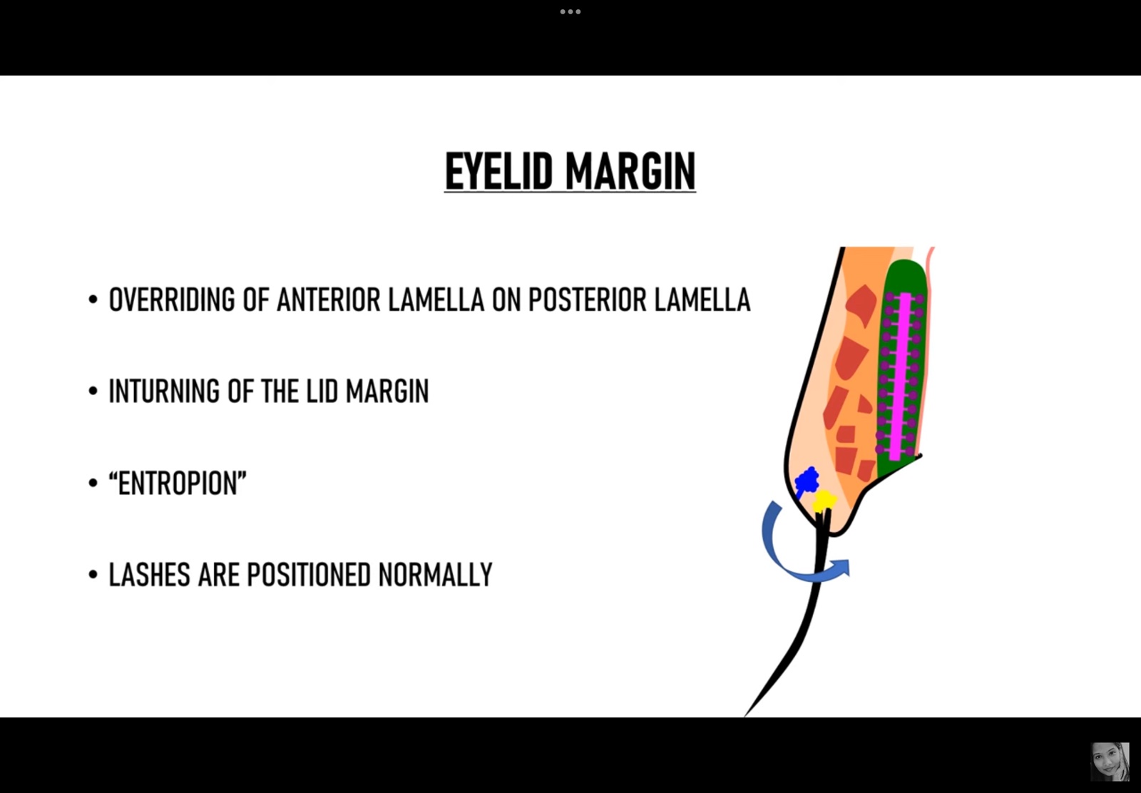 <p>Inward turning of the lid margin</p>