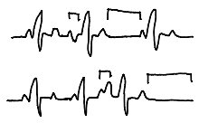 <p>irregular beats with premature P waves + non-compensatory pause</p>