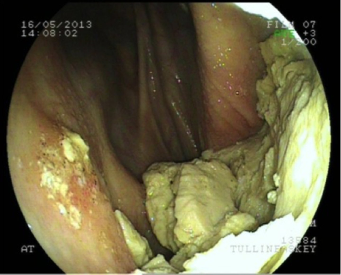 <p>Angiv diagnose</p><p>- Luftpose empyem</p><p>- Sinusitis</p><p>- Tracheitis</p><p>- Luftposemykose</p>