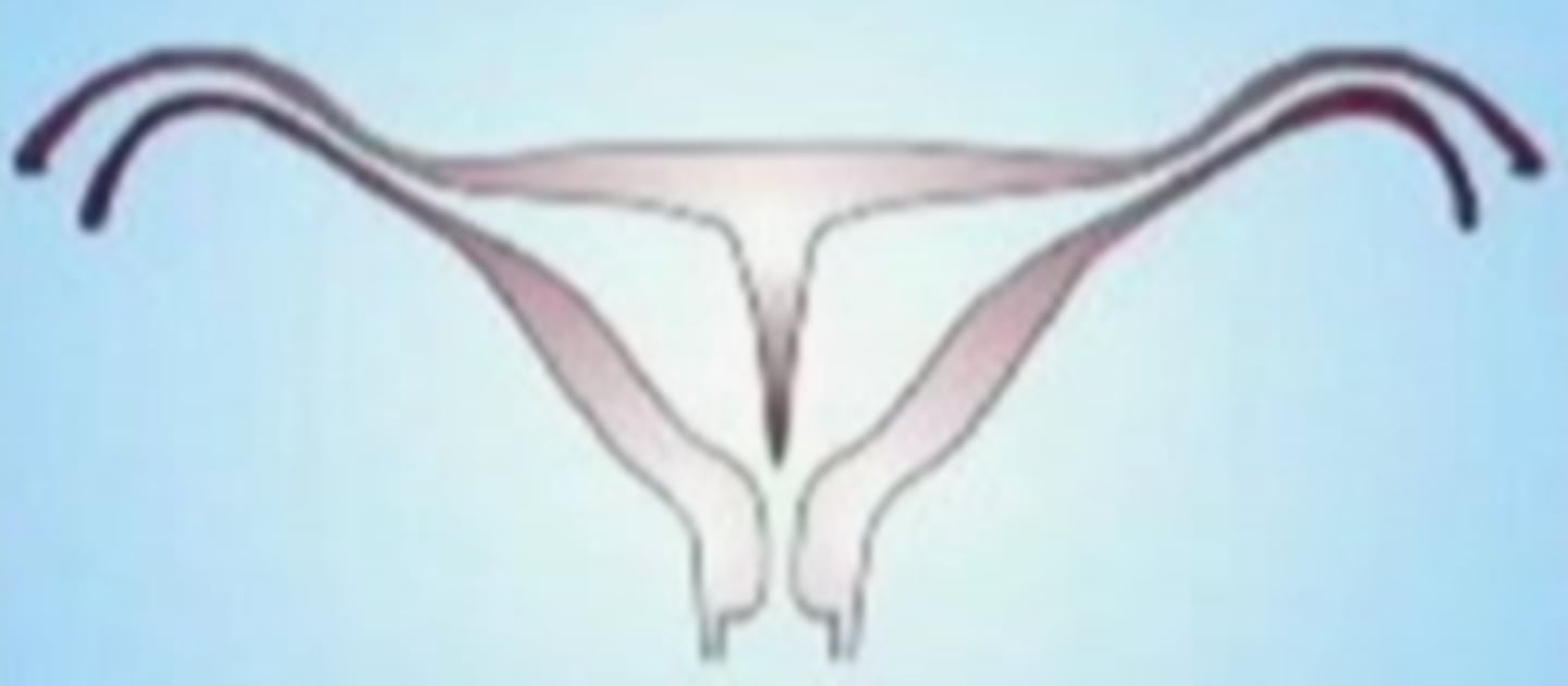 <p>Uterus with a partition in the middle.</p>
