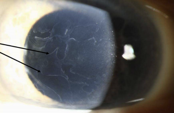 <p>Also known as Cogan’s microcystic epithelial dystrophy or map-dot-fingerprint dystrophy. </p>